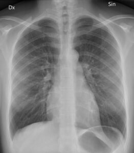 Posteroanterior chest radiograph ("X-ray") taken of a 21 year old woman who presented with pain on the left side of her thorax after colliding with another player during a soccer game. It shows a normal chest without any signs of injury. Dx and Sin stand for "right" and "left" respectively. Photo: Mikael Häggström