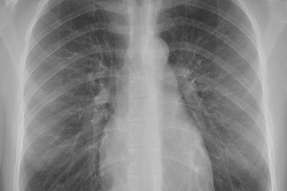 Posteroanterior chest radiograph ("X-ray") taken of a 21 year old woman who presented with pain on the left side of her thorax after colliding with another player during a soccer game. It shows a normal chest without any signs of injury. Dx and Sin stand for "right" and "left" respectively. Photo: Mikael Häggström